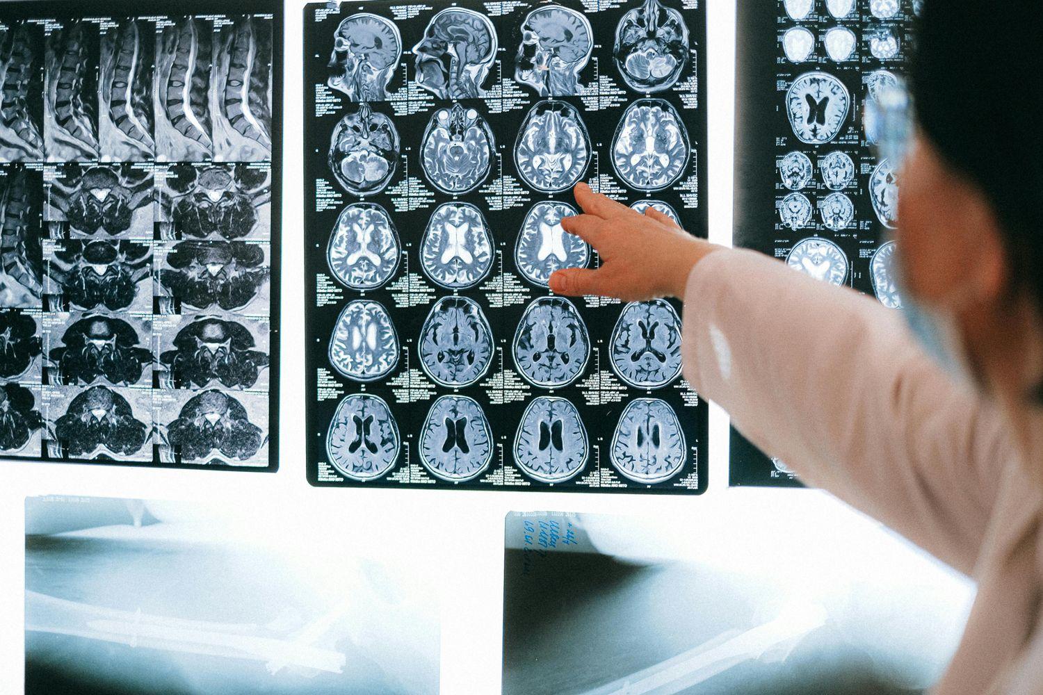 Aufnahme eines CT-Scans mit Abbildung der einzelnen Hirnareale und einer Frau, die auf die Abbildung deutet.