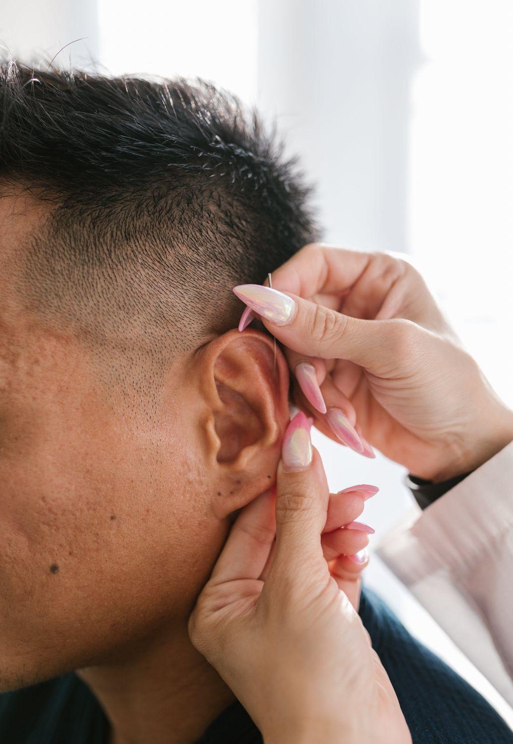 Nahaufnahme von einem Mann, der sich im Rahmen einer Tinnitus-Behandlung Akupunktur-Nadeln am Ohr setzen lässt.